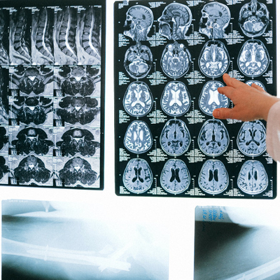 Película seca médica de inyección de tinta azul Película de rayos X azul transparente para el dispositivo radiológico de tomografía computarizada DR MRI