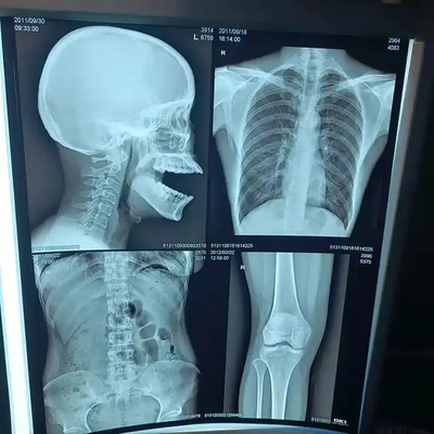 Película de rayos X médica de 200 ± 5 μM de espesor para diagnóstico de alta densidad