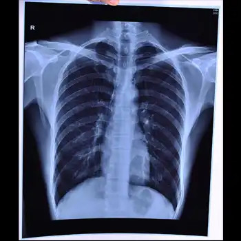 Película seca de rayos X médica Película de inyección de tinta de rayos X con calidad de imagen clara