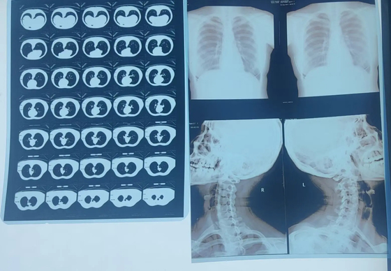 Sistema de imágenes médicas con película seca láser de rayos X para DR CR MRI Impresora de rayos X con ISO CE