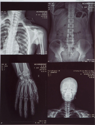 Película láser para la impresión de imágenes médicas de rayos X