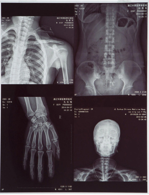 Película de inyección de tinta azul de halogenuro de plata para imágenes médicas