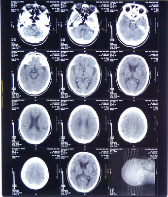 Película médica de rayos X de alta claridad FUJI DIHT 14*17in Película de imagen seca con láser
