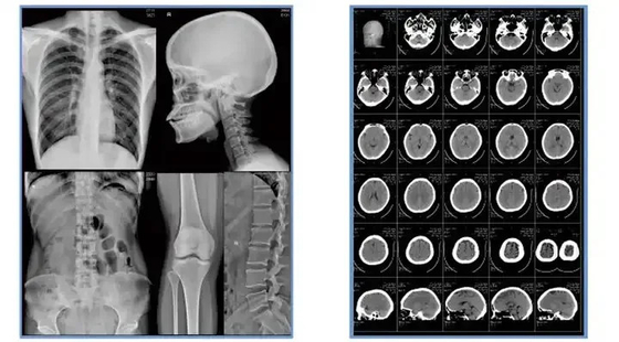 Película de inyección de tinta azul de halogenuro de plata para imágenes médicas