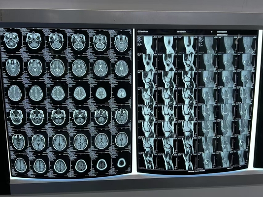 Impresión térmica azul con láser médico de rayos X para un diagnóstico preciso