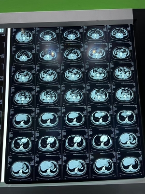 Película de impresión térmica de radiografía láser azul para equipos médicos de rayos X