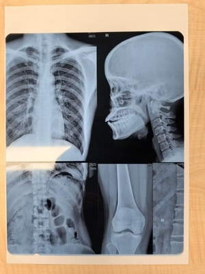 Ajuste automático de densidad de película láser de rayos X para imágenes médicas