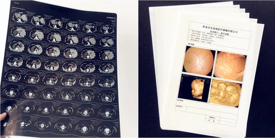 Materiales médicos Impresión con láser Película blanca opaca Película médica de rayos X Imagen de impresión Película para impresora de inyección de tinta Epson &amp; Canon