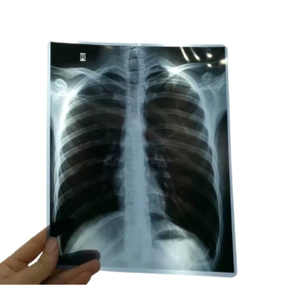 14*17 pulgadas de película de escaneo en seco para radiografías médicas/CT/DR para impresoras de imágenes láser de rayos X y equipos de impresoras térmicas