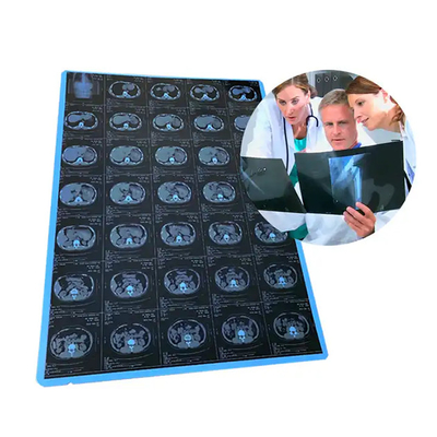 11*14 Tamaño de película de rayos X azul médico para impresión láser