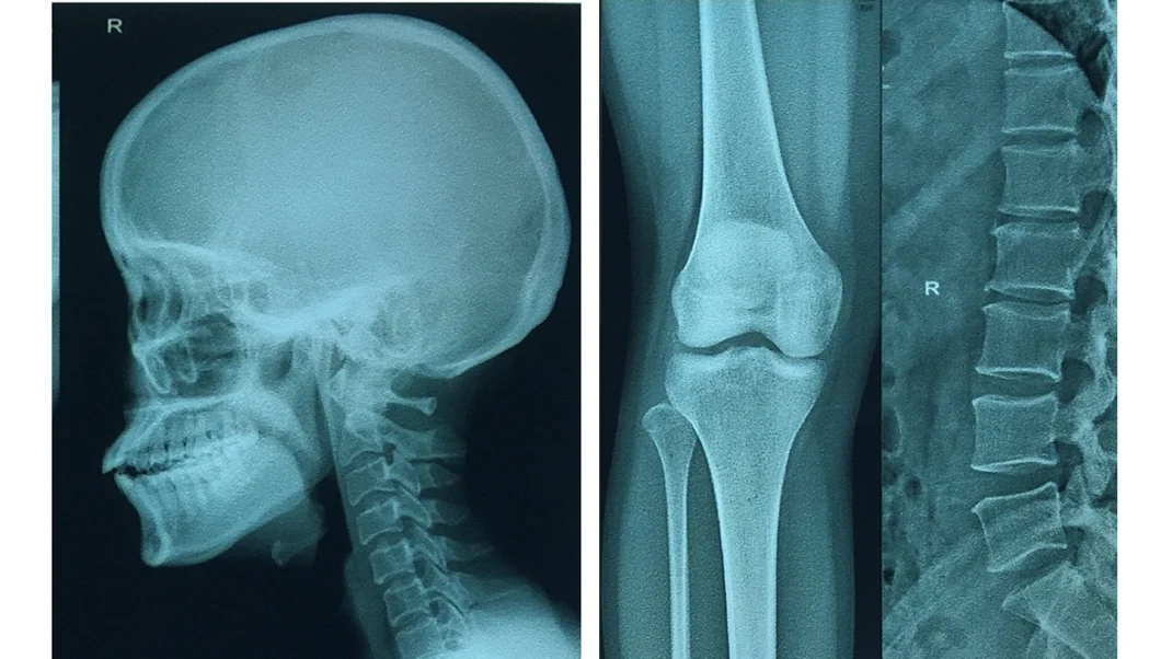 Blue Color 10X12 Inch Inkjet Pet Medical X-ray Film/Image