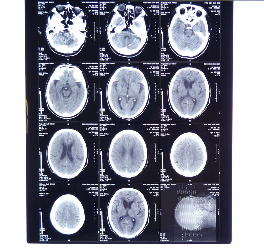 Printing Radiology Universal Medical Thermal Hospital Blue X-ray Film